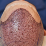 Saç Ekimi Başarı Oranı Nedir?