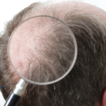 Hugh Laurie Saç Ekimi Yolculuğu