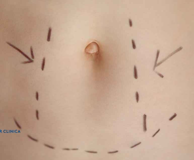 Mide Küçültme Ameliyatı Hakkında Kapsamlı Bir Rehber