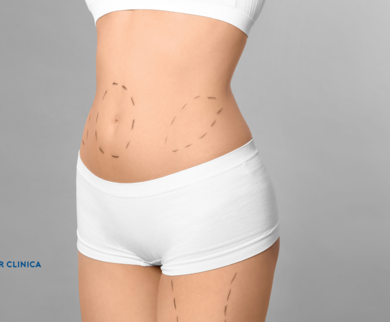 Karın Germe Ameliyatı (Abdominoplasti) Maliyeti ve İyileşme Süreci