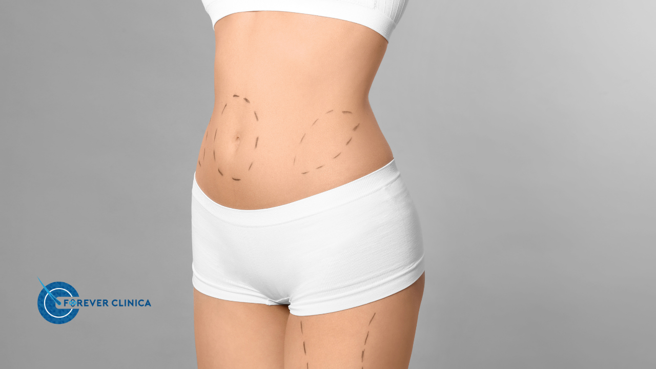 Karın Germe Ameliyatı (Abdominoplasti) Maliyeti ve İyileşme Süreci