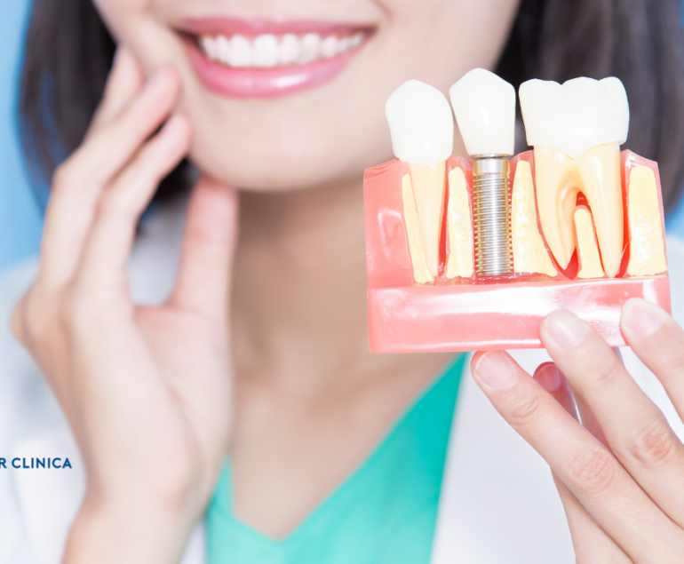 The Comprehensive Guide to Dental Implants