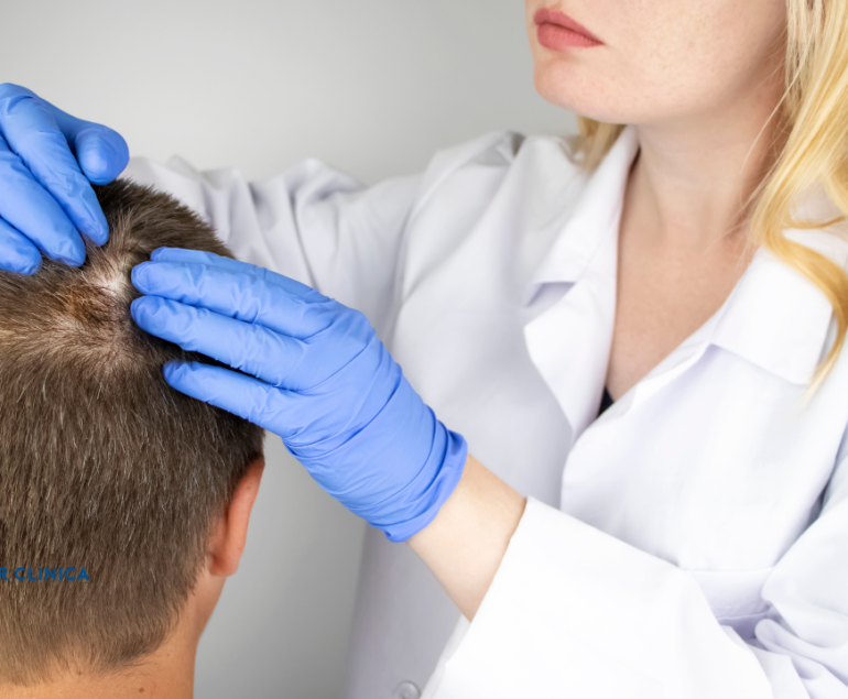 Saçkıran (Alopesi) Nedir?
