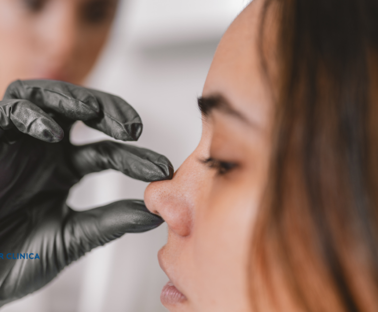 Burun Estetiği Ameliyatı Sonrası Ödem Sorunu