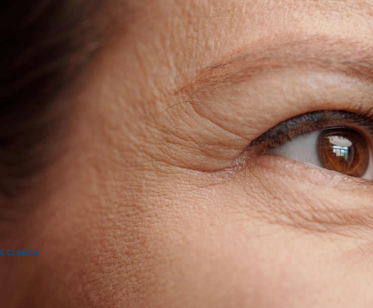 Crow's Feet Botox (Eye Wrinkles)