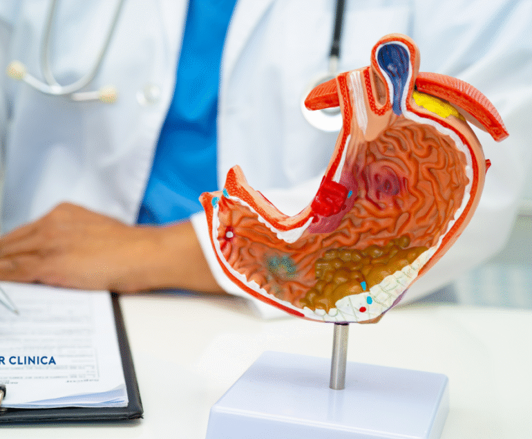 Ce este Bypass-ul Gastric
