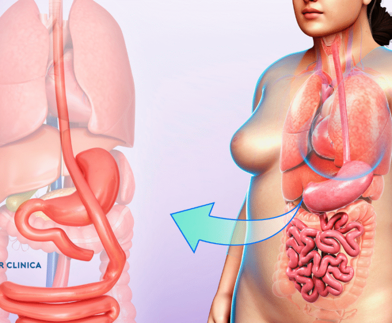 Care sunt tipurile de bypass gastric