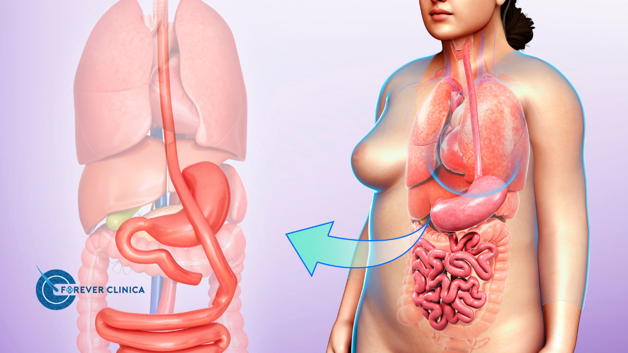 Care sunt tipurile de bypass gastric