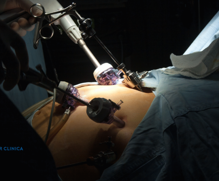 Care Sunt Posibilele Complicații în Timpul Operației de Bypass Gastric?