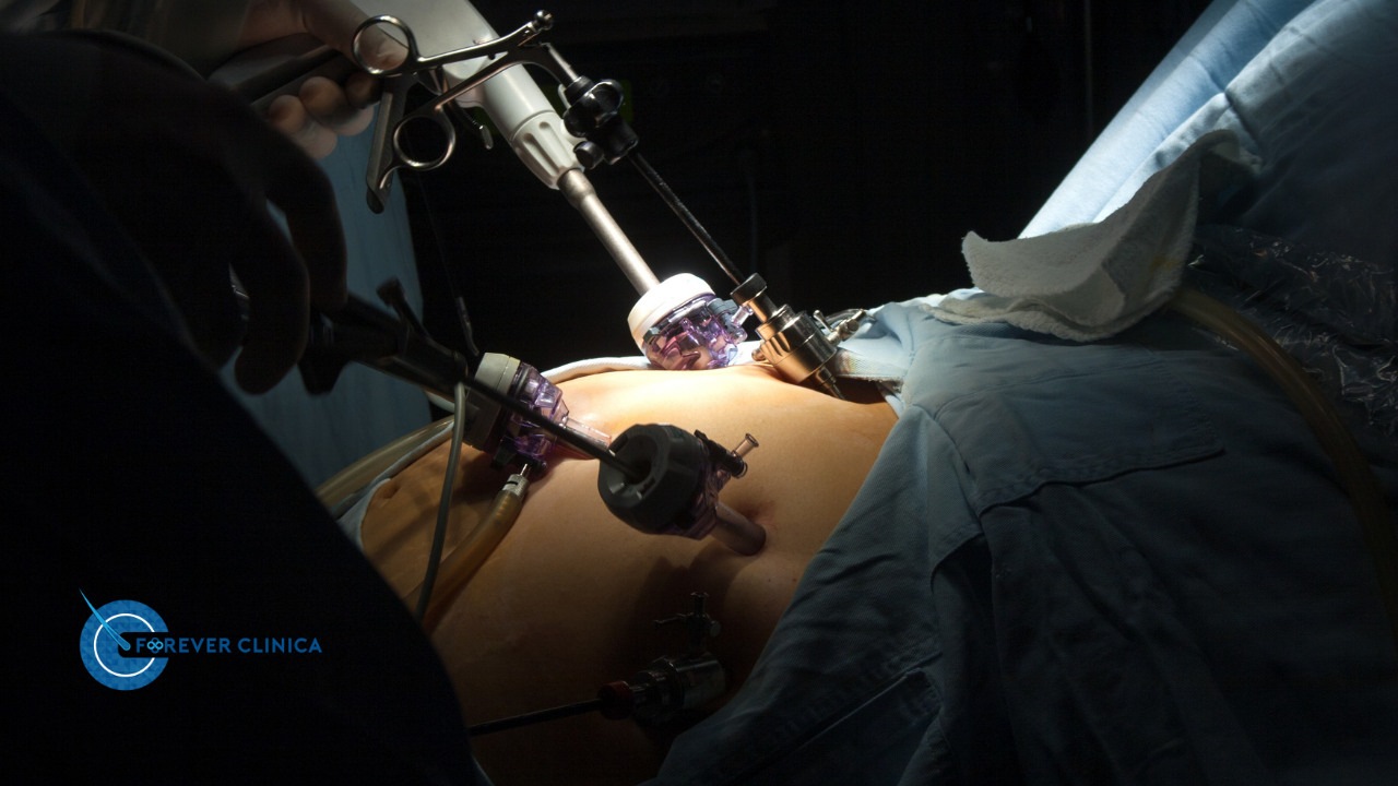 Care Sunt Posibilele Complicații în Timpul Operației de Bypass Gastric?