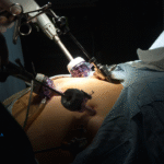 What Are the Possible Complications During Gastric Bypass Surgery?