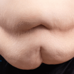 What is Morbid Obesity?