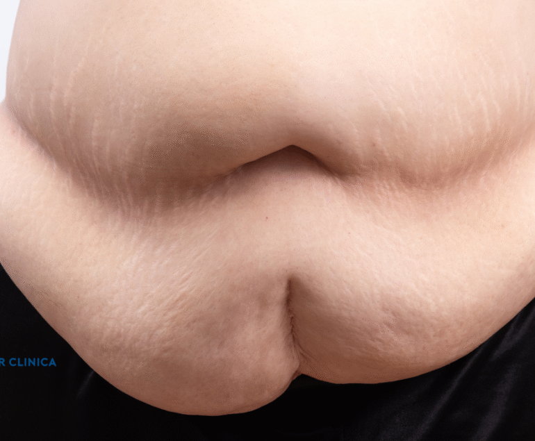 What is Morbid Obesity?