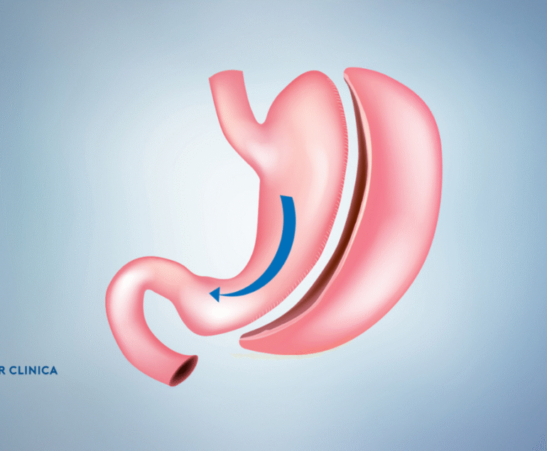 Sleeve Gastrektomi Nedir?