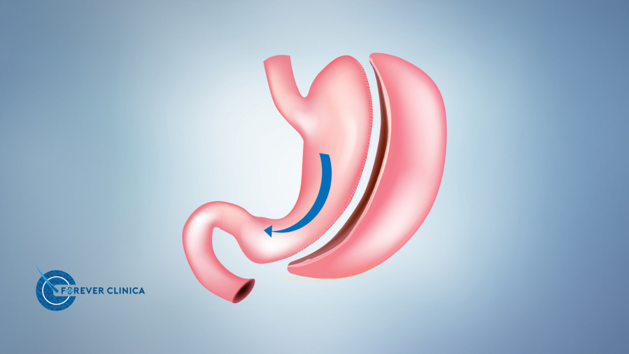 Sleeve Gastrektomi Nedir?