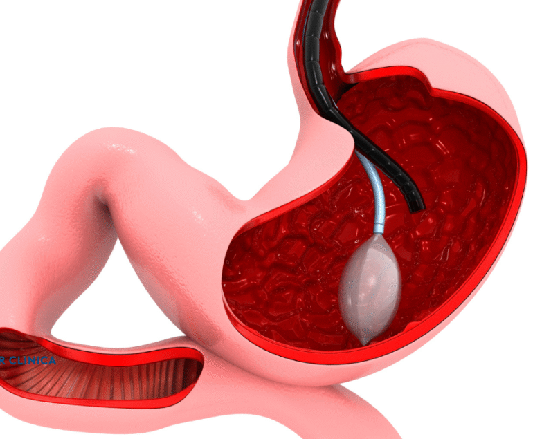 What Are the Risks of Sleeve Gastrectomy Surgery?