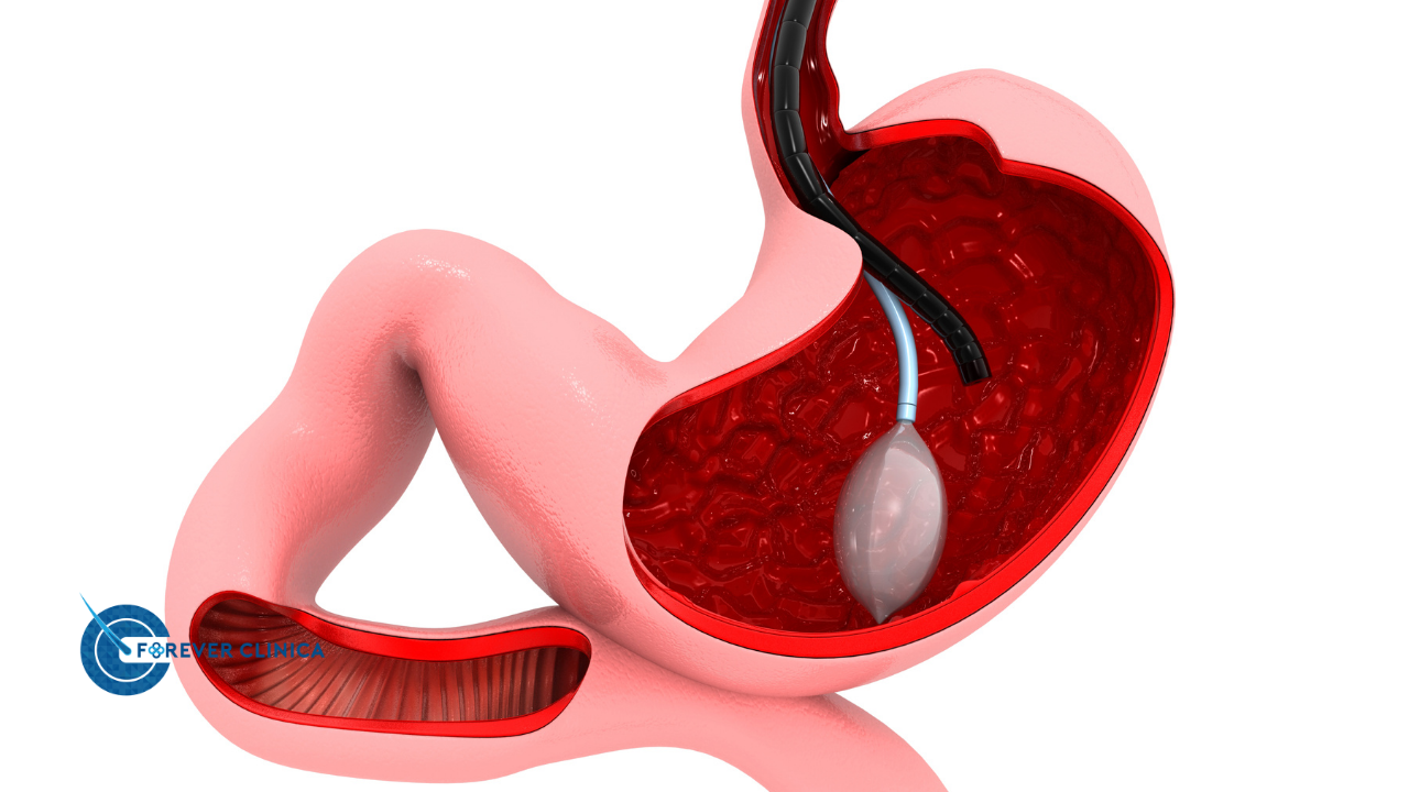 What Are the Risks of Sleeve Gastrectomy Surgery?