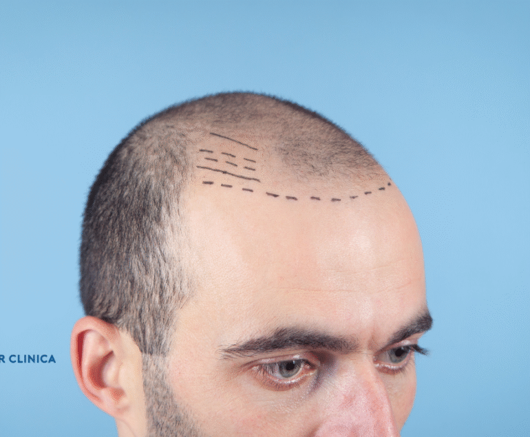 How to Relieve Pain, Itching, and Pimples in the Donor Area After a Hair Transplant