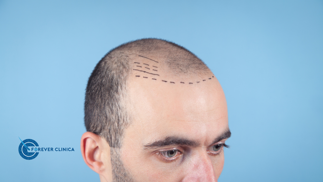 How to Relieve Pain, Itching, and Pimples in the Donor Area After a Hair Transplant