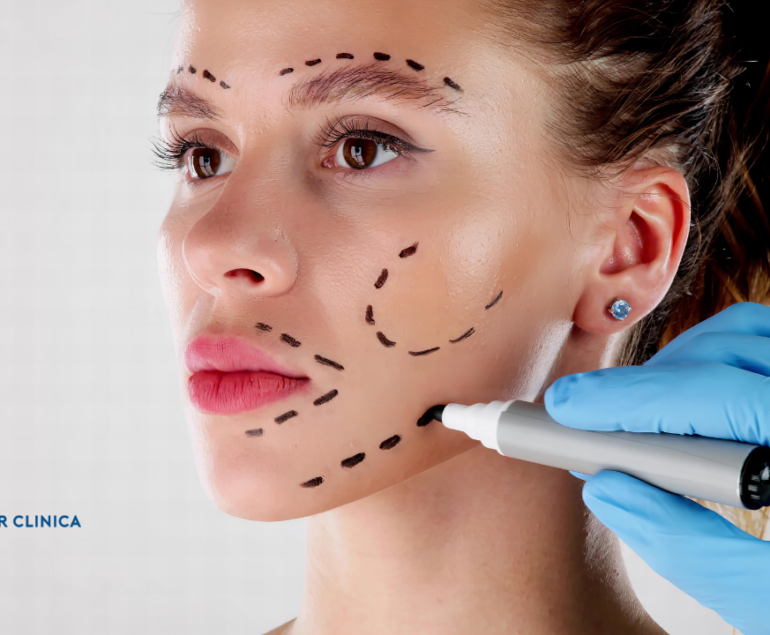 What is a Facelift Operation? Facelift Surgery. Facelift Surgery