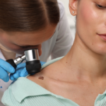 What is Nevus Excision? Nevus Excision Treatment