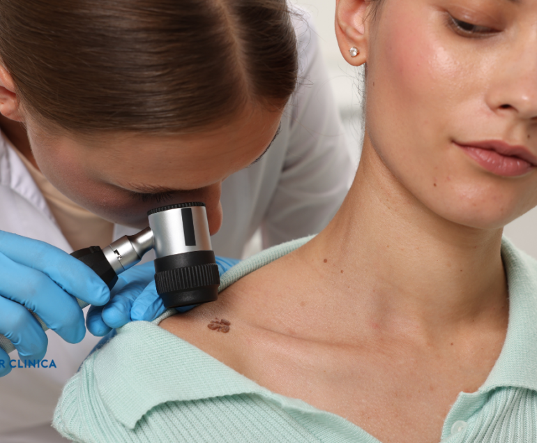 Что такое удаление невуса? Лечение методом удаления невуса