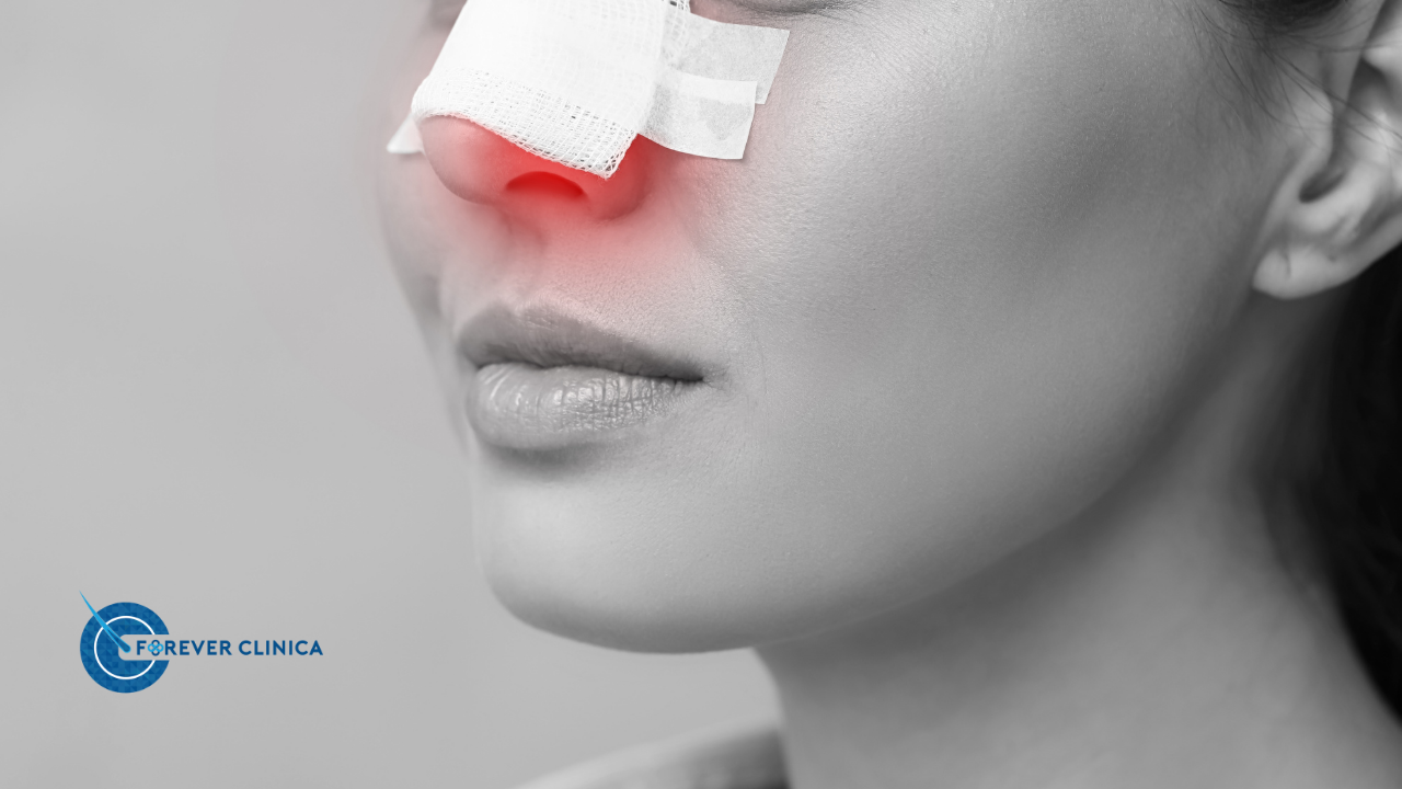 Burun Estetiği İyileşme Süreci Tamponlar Ne Zaman Çıkar