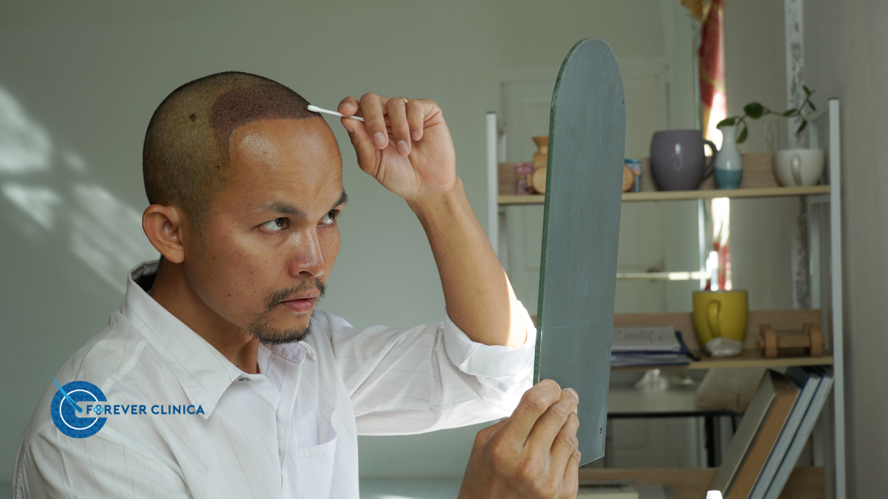 First 10 Days After Hair Transplantation