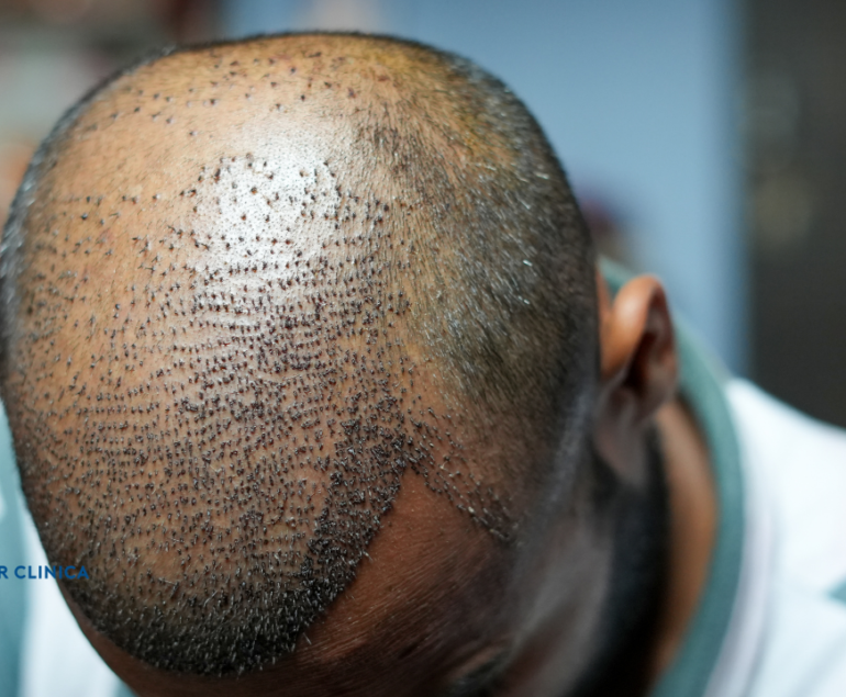 Primele 10 Zile După Transplantul de Păr Spălarea și Căderea Crustelor