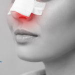 Procesul de recuperare după rinoplastie Când se scot tampoanele