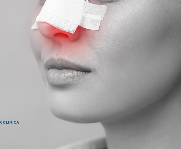 Rhinoplasty Recovery Process When Are the Packings Removed