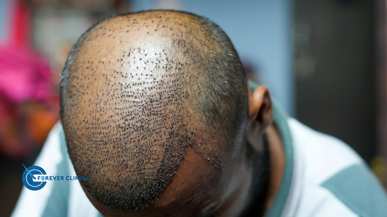 Первые 10 дней после пересадки волос Мытье и отхождение корочек