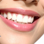 How is a Hollywood Smile Design done