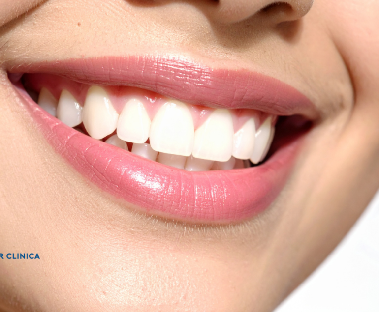 How is a Hollywood Smile Design done